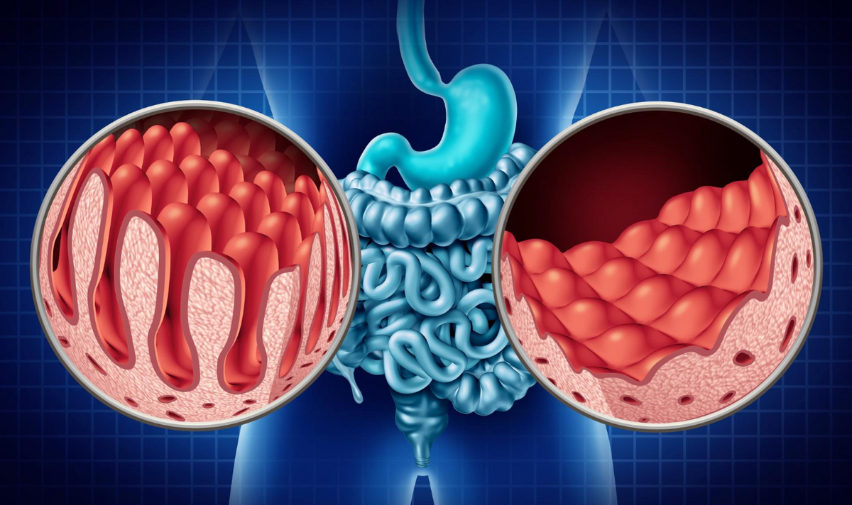 celiac disease: do people that do not have it need to avoid gluten?