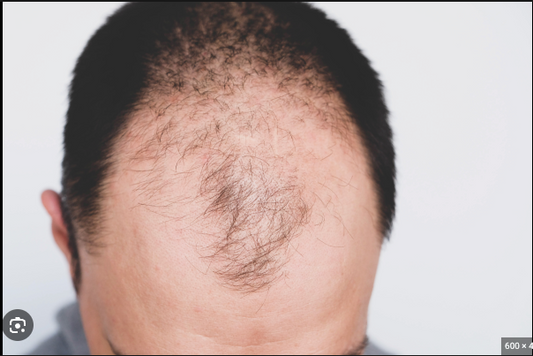 stop male pattern balding